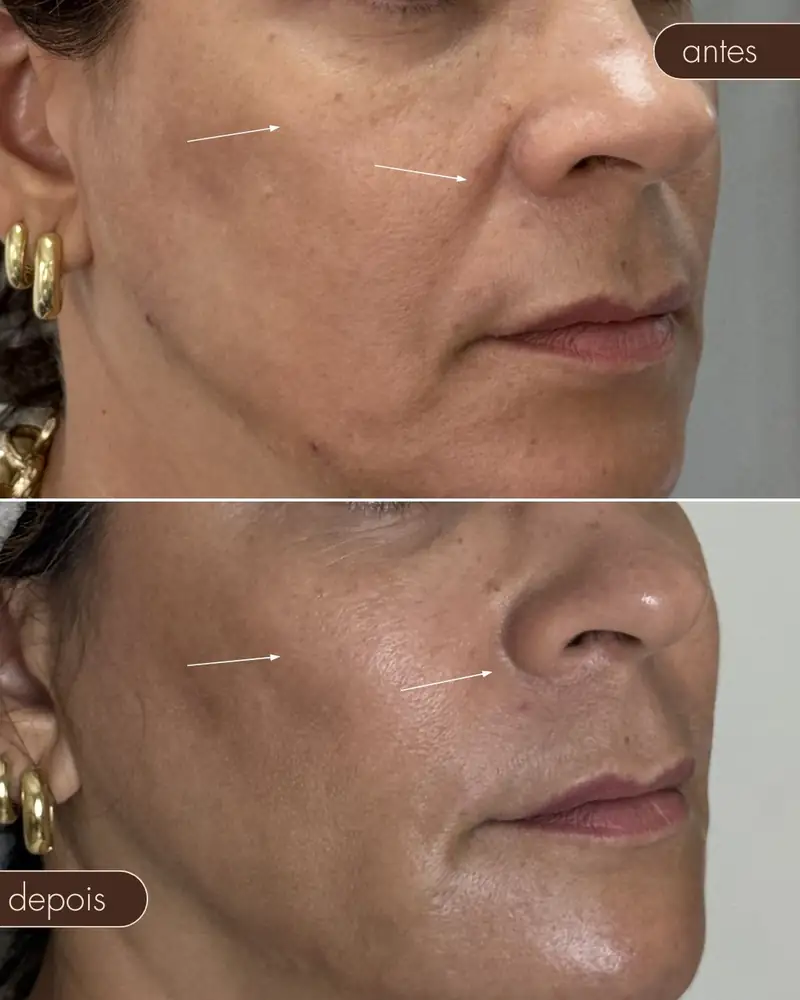 Antes e depois — Preenchimento de malar